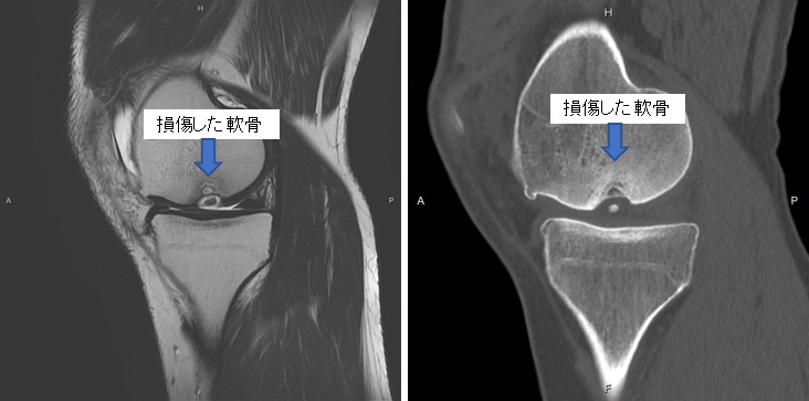 図1 MRI・CTでみえる離断性骨軟骨炎