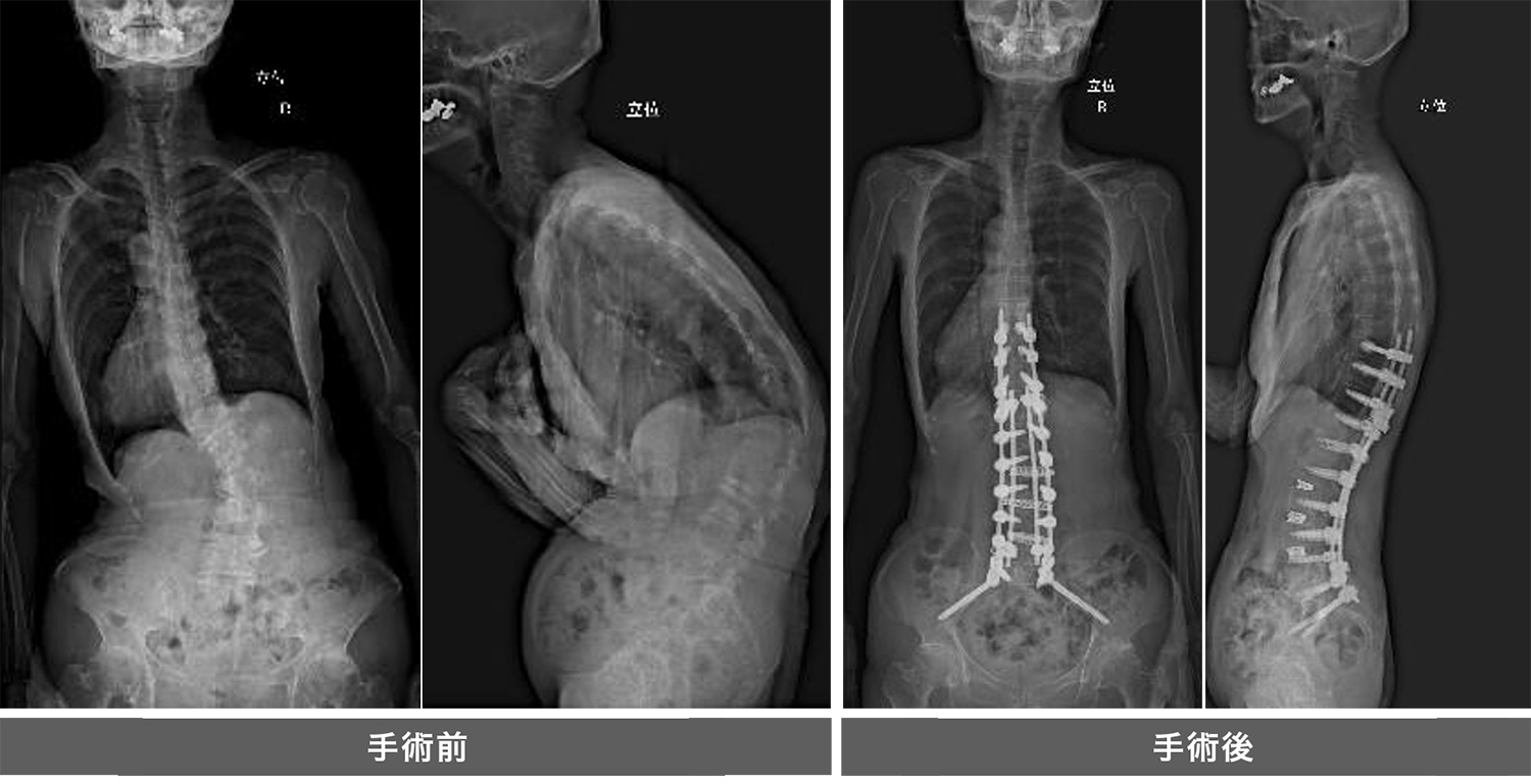 成人脊柱変形、思春期特発性側弯症に対する矯正固定術