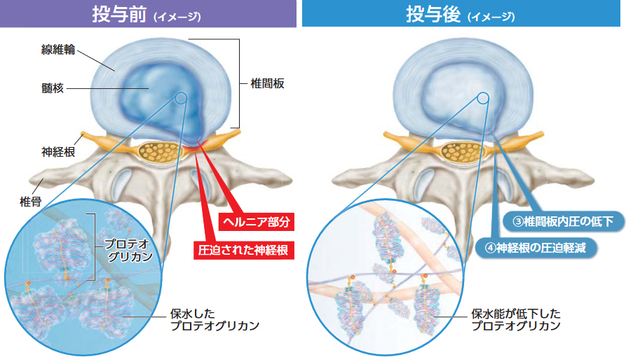 骨粗鬆性椎体圧壊に対する経皮的椎体形成術