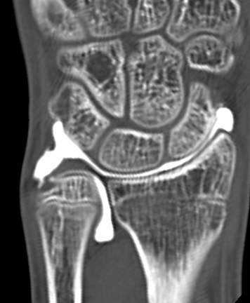 手関節造影後CT