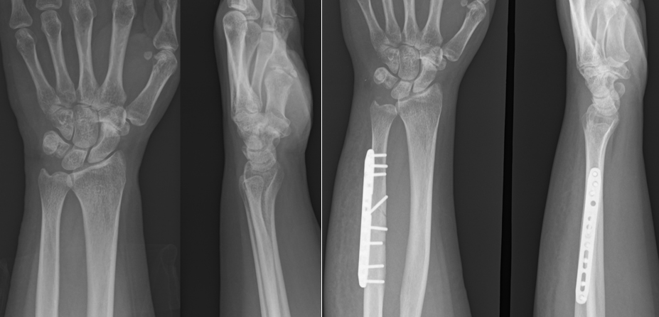尺骨短縮骨切り術（術前と術後）